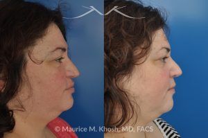 Photo of a patient before and after a procedure. Nasal Valve Repair with Rib Cartilage Graft - Nasal valve repair (repair of nasal vestibular stenosis) with rib cartilage graft.