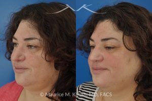 Photo of a patient before and after a procedure. Nasal Valve Repair with Rib Cartilage Graft - Nasal valve repair (repair of nasal vestibular stenosis) with rib cartilage graft.