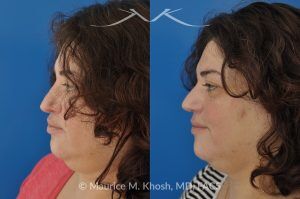 Photo of a patient before and after a procedure. Nasal Valve Repair with Rib Cartilage Graft - Nasal valve repair (repair of nasal vestibular stenosis) with rib cartilage graft.