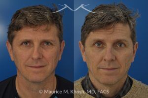 Photo of a patient before and after a procedure. Nasal Valve Repair with Cadaver Rib Cartilage - Repair of nasal vestibular stenosis using cadaver rib cartilage as spreader grafts to widen the internal nasal valve by Dr. Maurice Khosh.