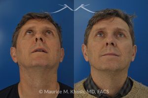 Photo of a patient before and after a procedure. Nasal Valve Repair with Cadaver Rib Cartilage - Repair of nasal vestibular stenosis using cadaver rib cartilage as spreader grafts to widen the internal nasal valve by Dr. Maurice Khosh.