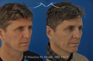 Photo of a patient before and after a procedure. Nasal Valve Repair with Cadaver Rib Cartilage - Repair of nasal vestibular stenosis using cadaver rib cartilage as spreader grafts to widen the internal nasal valve by Dr. Maurice Khosh.