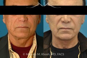 Photo of a patient before and after a procedure. Direct Neck Lift with Grecian Urn Technique - This 73 year old gentleman, with past facelift surgery, complained of central neck skin laxity and 'turkey wattles'. The neck skin and muscle was tightened with the Grecian Urn direct neck lift technique.
