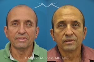 Photo of a patient before and after a procedure. Conservative SMAS Facelift with Neck Lift - 66 year old man who wanted tightening of neck skin and improvement in the jowls while maintaining a natural an un-operated look. A conservative SMAS facelift with simultaneous neck lift helped achieve his desired goals.