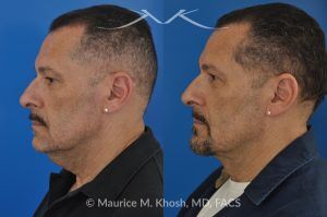 Photo of a patient before and after a procedure. Direct Neck Lift with Lipoma Removal - Necklift performed directly through a midline neck incision. Simultaneous removal of benign fatty tumor of the neck (lipoma) through the same approach