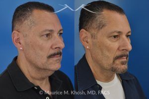 Photo of a patient before and after a procedure. Direct Neck Lift with Lipoma Removal - Necklift performed directly through a midline neck incision. Simultaneous removal of benign fatty tumor of the neck (lipoma) through the same approach