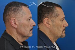 Photo of a patient before and after a procedure. Direct Neck Lift with Lipoma Removal - Necklift performed directly through a midline neck incision. Simultaneous removal of benign fatty tumor of the neck (lipoma) through the same approach