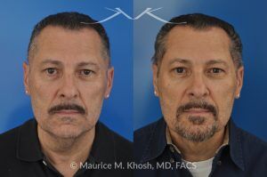 Photo of a patient before and after a procedure. Direct Neck Lift with Lipoma Removal - Necklift performed directly through a midline neck incision. Simultaneous removal of benign fatty tumor of the neck (lipoma) through the same approach