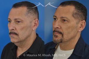 Photo of a patient before and after a procedure. Direct Neck Lift with Lipoma Removal - Necklift performed directly through a midline neck incision. Simultaneous removal of benign fatty tumor of the neck (lipoma) through the same approach