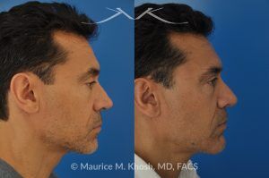 Photo of a patient before and after a procedure. Repair of Nasal Valve Obstruction with Revision Rhinoplasty - This gentleman had previously undergone two rhinoplasty operations over 15 years ago. His nasal tip was pinched and obstructing his breathing, Cadaver rib cartilage was used to strengthen and support his external nasal valve. The nasal tip was slightly elevated.