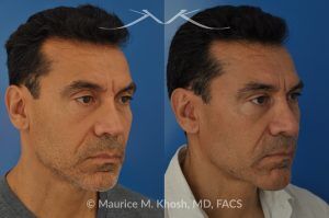 Photo of a patient before and after a procedure. Repair of Nasal Valve Obstruction with Revision Rhinoplasty - This gentleman had previously undergone two rhinoplasty operations over 15 years ago. His nasal tip was pinched and obstructing his breathing, Cadaver rib cartilage was used to strengthen and support his external nasal valve. The nasal tip was slightly elevated.