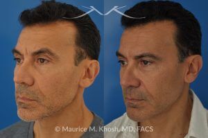 Photo of a patient before and after a procedure. Repair of Nasal Valve Obstruction with Revision Rhinoplasty - This gentleman had previously undergone two rhinoplasty operations over 15 years ago. His nasal tip was pinched and obstructing his breathing, Cadaver rib cartilage was used to strengthen and support his external nasal valve. The nasal tip was slightly elevated.