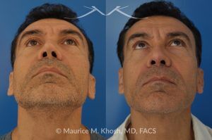 Photo of a patient before and after a procedure. Repair of Nasal Valve Obstruction with Revision Rhinoplasty - This gentleman had previously undergone two rhinoplasty operations over 15 years ago. His nasal tip was pinched and obstructing his breathing, Cadaver rib cartilage was used to strengthen and support his external nasal valve. The nasal tip was slightly elevated.