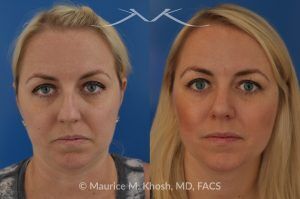Photo of a patient before and after a procedure. Bilateral Nasal Valve Repair - Includes spreader grafts and tip rhinoplasty to improve nasal airflow and tip symmetry.