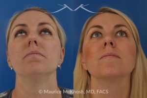 Photo of a patient before and after a procedure. Bilateral Nasal Valve Repair - Includes spreader grafts and tip rhinoplasty to improve nasal airflow and tip symmetry.