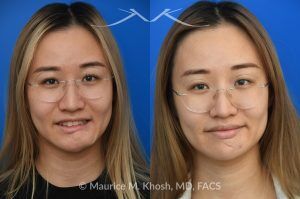 Photo of a patient before and after a procedure. Chin Scar Revision with Flap Defatting for Improved Lip Position - This young patient had skin cancer in the chin which was removed and repaired with a bilobed flap from the lower chin. This resulted in a swollen and puffy chin with malposition of the lower lip. Following scar revision, the chin fullness is improved and the lower lip position is now normalized.