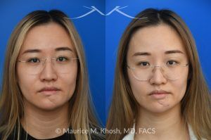 Photo of a patient before and after a procedure. Chin Scar Revision with Flap Defatting for Improved Lip Position - This young patient had skin cancer in the chin which was removed and repaired with a bilobed flap from the lower chin. This resulted in a swollen and puffy chin with malposition of the lower lip. Following scar revision, the chin fullness is improved and the lower lip position is now normalized.