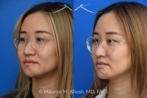 Photo of a patient before and after a procedure. Chin Scar Revision with Flap Defatting for Improved Lip Position - This young patient had skin cancer in the chin which was removed and repaired with a bilobed flap from the lower chin. This resulted in a swollen and puffy chin with malposition of the lower lip. Following scar revision, the chin fullness is improved and the lower lip position is now normalized.