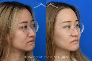 Photo of a patient before and after a procedure. Chin Scar Revision with Flap Defatting for Improved Lip Position - This young patient had skin cancer in the chin which was removed and repaired with a bilobed flap from the lower chin. This resulted in a swollen and puffy chin with malposition of the lower lip. Following scar revision, the chin fullness is improved and the lower lip position is now normalized.