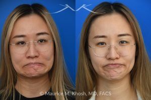 Photo of a patient before and after a procedure. Chin Scar Revision with Flap Defatting for Improved Lip Position - This young patient had skin cancer in the chin which was removed and repaired with a bilobed flap from the lower chin. This resulted in a swollen and puffy chin with malposition of the lower lip. Following scar revision, the chin fullness is improved and the lower lip position is now normalized.