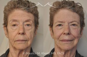 Photo of a patient before and after a procedure. Voluma Filler - before and after photo.