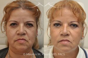 Photo of a patient before and after a procedure. Voluma Filler Injection and Botox Treatment by Dr. Maurice Khosh - before and after photo.