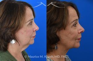 Photo of a patient before and after a procedure. Facelift for Natural Facial Rejuvenation and Lower Face Contouring - This is a 75 year-old who wanted to get rid of her neck waddle. She did not wish to have a full facelift operation as she was only concerned about the neck. A deep-plane neck lift was performed through a perfectly hidden incision under the chin. Excess fat was removed and the neck muscles were tightened. There are no incisions round the ears. The patient never took any pain medication. She is ecstatic with her results.