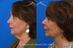 Photo of a patient before and after a procedure. Facelift for Natural Facial Rejuvenation and Lower Face Contouring - This is a 75 year-old who wanted to get rid of her neck waddle. She did not wish to have a full facelift operation as she was only concerned about the neck. A deep-plane neck lift was performed through a perfectly hidden incision under the chin. Excess fat was removed and the neck muscles were tightened. There are no incisions round the ears. The patient never took any pain medication. She is ecstatic with her results.