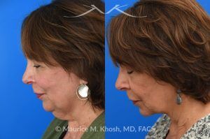 Photo of a patient before and after a procedure. Facelift for Natural Facial Rejuvenation and Lower Face Contouring - This is a 75 year-old who wanted to get rid of her neck waddle. She did not wish to have a full facelift operation as she was only concerned about the neck. A deep-plane neck lift was performed through a perfectly hidden incision under the chin. Excess fat was removed and the neck muscles were tightened. There are no incisions round the ears. The patient never took any pain medication. She is ecstatic with her results.
