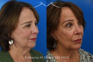 Photo of a patient before and after a procedure. Facelift for Natural Facial Rejuvenation and Lower Face Contouring - This is a 75 year-old who wanted to get rid of her neck waddle. She did not wish to have a full facelift operation as she was only concerned about the neck. A deep-plane neck lift was performed through a perfectly hidden incision under the chin. Excess fat was removed and the neck muscles were tightened. There are no incisions round the ears. The patient never took any pain medication. She is ecstatic with her results.