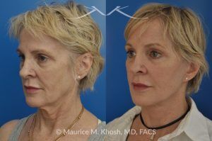 Photo of a patient before and after a procedure. SMAS Facelift with Neck and Temporal Brow Lift - 65 years old lady interested in improving her sagging neck, eliminating her jowls, and elevating the droopy eyebrow position. She underwent SMAS facelift, neck lift, and temporal brow lift.
