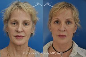 Photo of a patient before and after a procedure. SMAS Facelift with Neck and Temporal Brow Lift - 65 years old lady interested in improving her sagging neck, eliminating her jowls, and elevating the droopy eyebrow position. She underwent SMAS facelift, neck lift, and temporal brow lift.