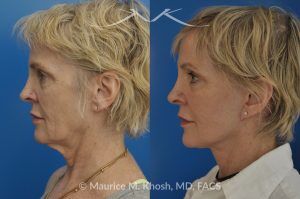 Photo of a patient before and after a procedure. SMAS Facelift with Neck and Temporal Brow Lift - 65 years old lady interested in improving her sagging neck, eliminating her jowls, and elevating the droopy eyebrow position. She underwent SMAS facelift, neck lift, and temporal brow lift.