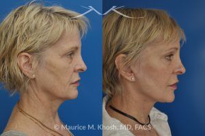 Photo of a patient before and after a procedure. SMAS Facelift with Neck and Temporal Brow Lift - 65 years old lady interested in improving her sagging neck, eliminating her jowls, and elevating the droopy eyebrow position. She underwent SMAS facelift, neck lift, and temporal brow lift.