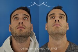 Photo of a patient before and after a procedure. Left-Sided Nasal Valve Repair with Spreader Graft - pre- and post-operative.
