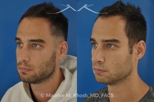 Photo of a patient before and after a procedure. Left-Sided Nasal Valve Repair with Spreader Graft - pre- and post-operative.