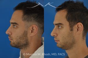 Photo of a patient before and after a procedure. Left-Sided Nasal Valve Repair with Spreader Graft - pre- and post-operative.