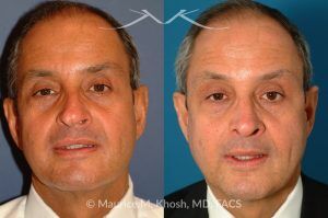 Photo of a patient before and after a procedure. Nasal Valve Repair with Septoplasty - pre- and post-operative.
