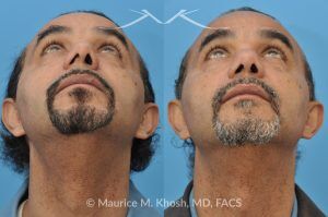 Photo of a patient before and after a procedure. Nasal Valve Repair with Septoplasty - pre- and post-operative.