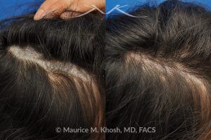 Photo of a patient before and after a procedure. Scalp Scar Revision with Improved Hair Growth - This 28 year-old lady had undergone scalp surgery which resulted in a wide and bald scar of the scalp which could not be fully camouflaged with her long hair. Scar revision of the scalp was performed inr Manhattan. The scar is more narrow and there is hair growth through the scar for further camouflage. 