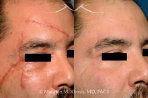 Photo of a patient before and after a procedure. Scar Revision of Forehead and Upper Face - pre- and post-operative.