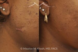 Photo of a patient before and after a procedure. Scar Revision of Right Cheek - pre- and post-operative.