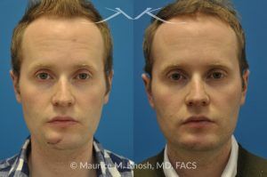 Photo of a patient before and after a procedure. Scar Revision of Chin Due to Traumatic Laceration - pre- and post-operative.