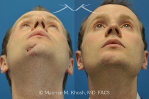 Photo of a patient before and after a procedure. Scar Revision of Chin Due to Traumatic Laceration - pre- and post-operative.
