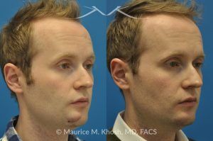 Photo of a patient before and after a procedure. Scar Revision of Chin Due to Traumatic Laceration - pre- and post-operative.