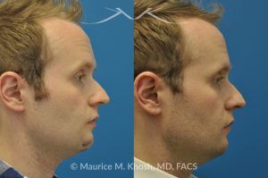 Photo of a patient before and after a procedure. Scar Revision of Chin Due to Traumatic Laceration - pre- and post-operative.