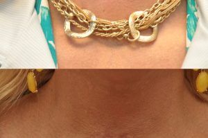 Photo of a patient before and after a procedure. Scar Revision of the Chin - pre- and post-operative.