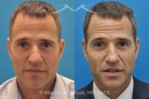 Photo of a patient before and after a procedure. Rhinoplasty for Twisted Nose - pre- and post-operative.