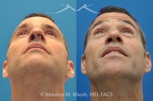 Photo of a patient before and after a procedure. Rhinoplasty for Twisted Nose - pre- and post-operative.