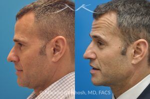 Photo of a patient before and after a procedure. Rhinoplasty for Twisted Nose - pre- and post-operative.